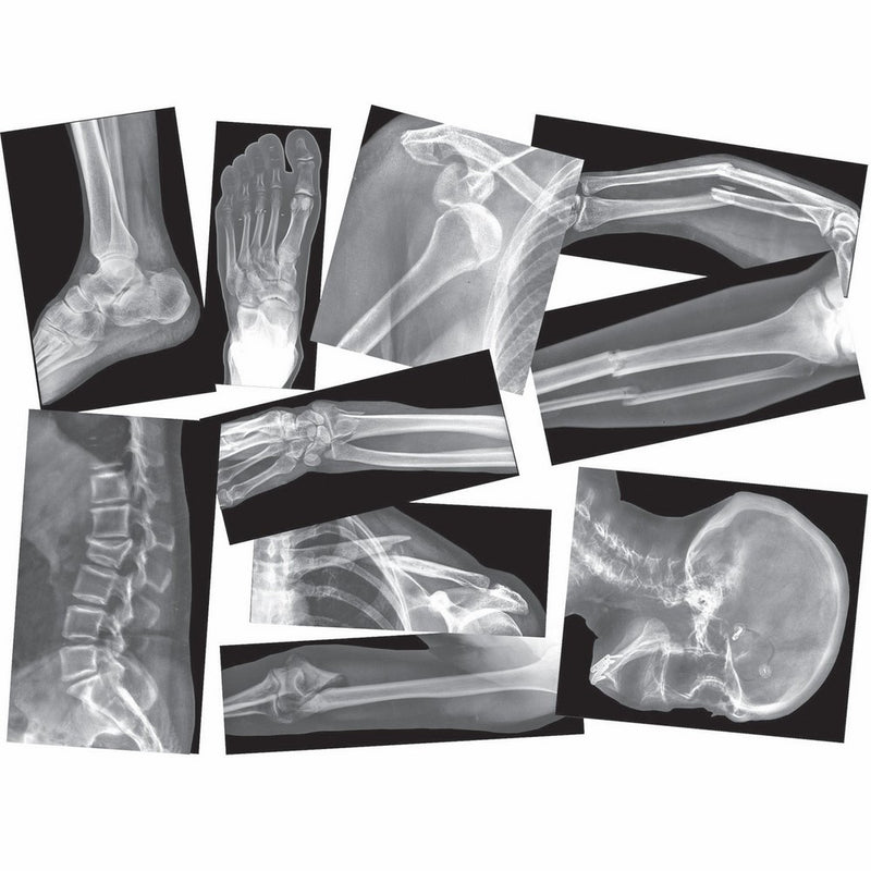 Roylco Broken Bones X-Ray Set